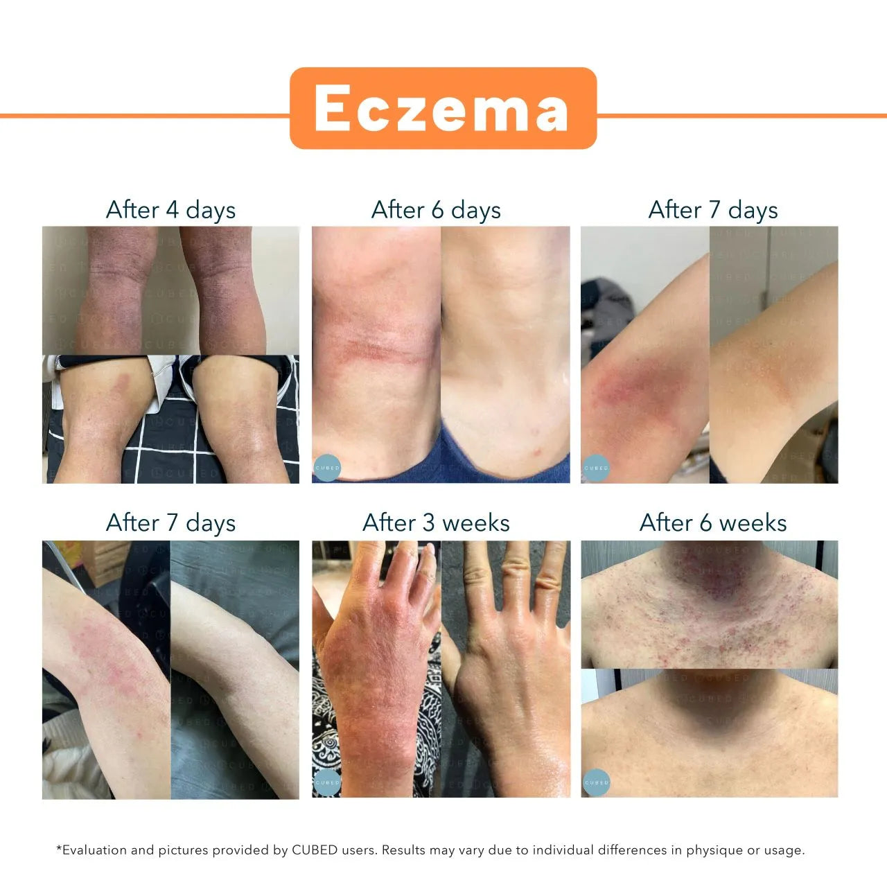 Topical Steroid Withdrawal Savior