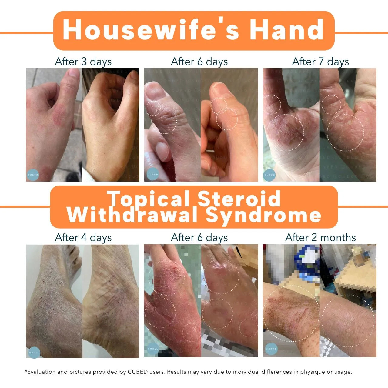Topical Steroid Withdrawal Savior
